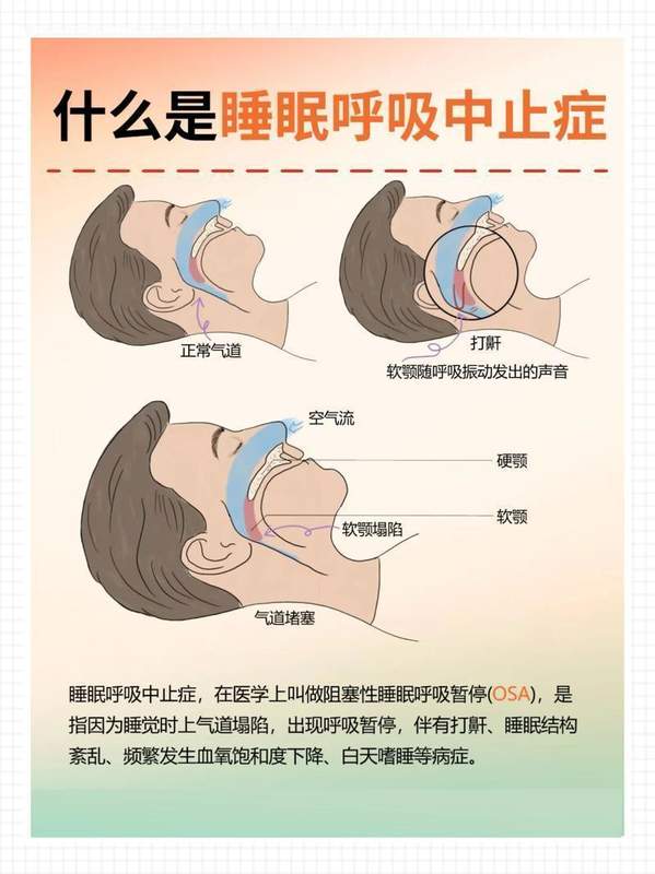  中年男子频发车祸，疑似厄运缠身；医生揭秘真相：夜间呼吸异常竟超五百次。 健康养生